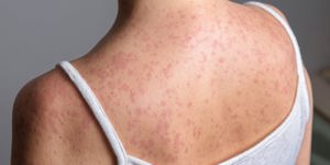 Measles elimination status in the United States and  ...